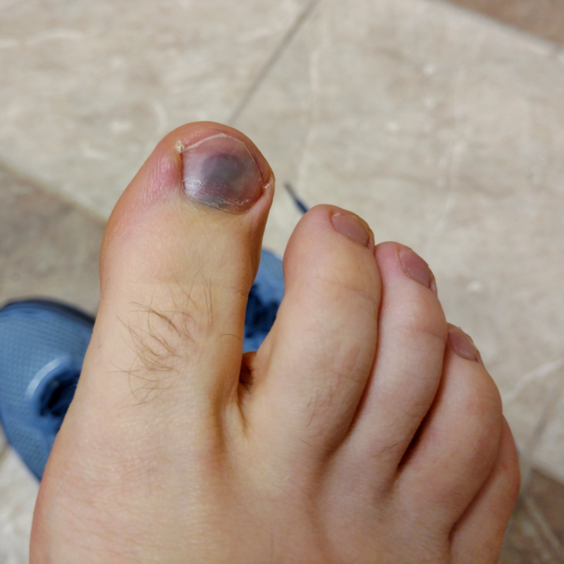 Illustration for article titled Hopefully my toe isn't broken! (UPDATED)